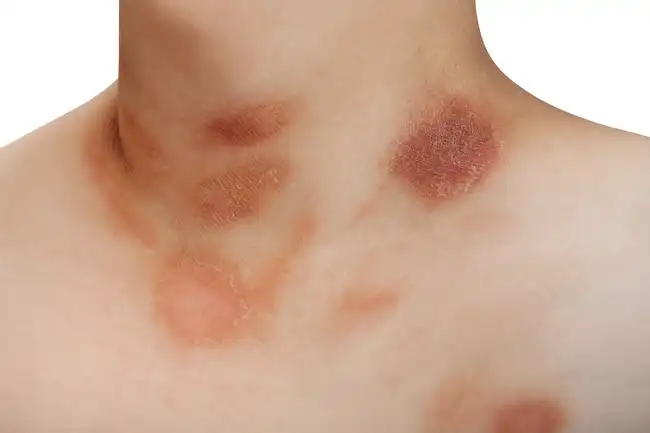 Pictures: Weird Skin Reactions