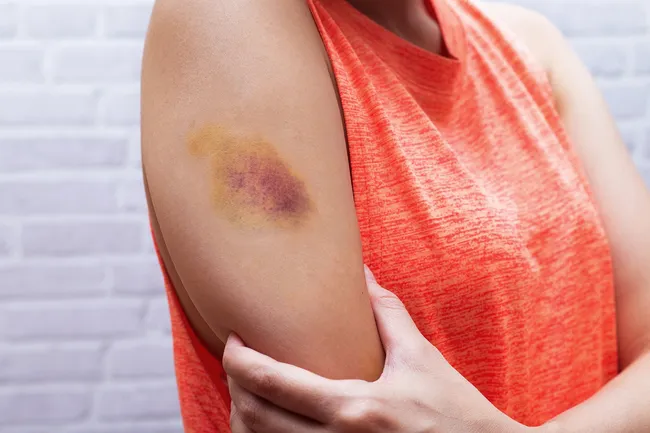 photo of woman with bruise on arm