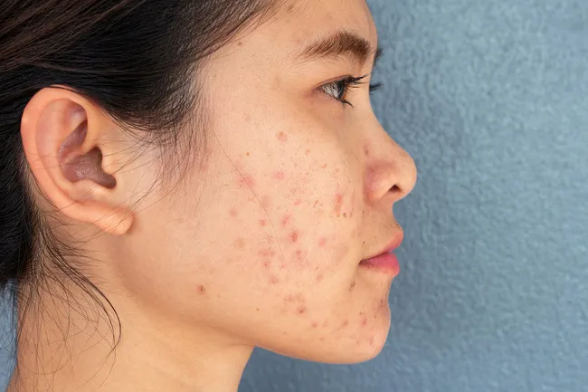 photo of woman with facial acne