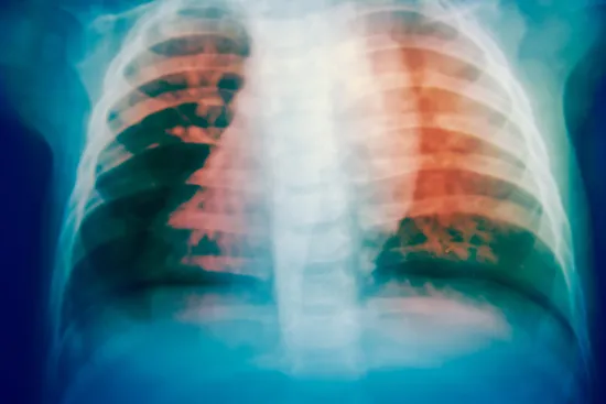 x-ray of tuberculosis