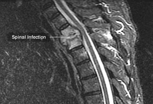 spinal infection mri