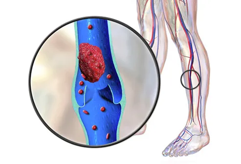 deep vein thrombosis illustration