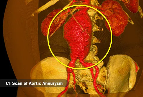 aortic aneurism
