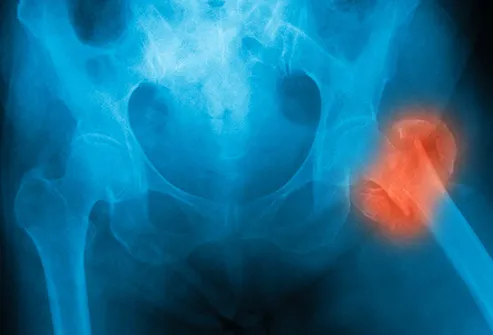 xray of broken femur near hip