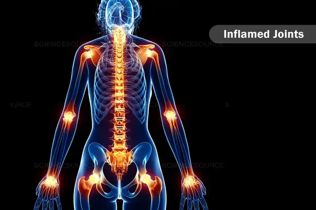 inflamed joints