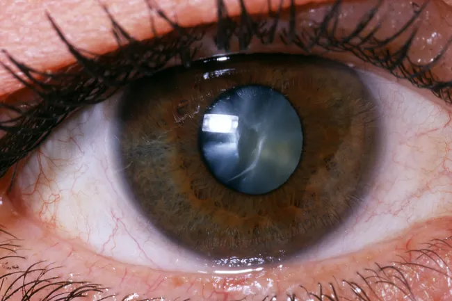 cataract close up