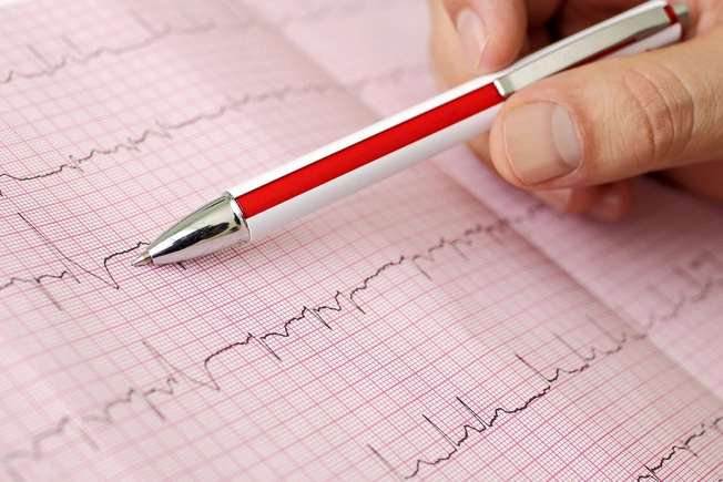 Arrhythmia: A Problem With Your Heart Rate