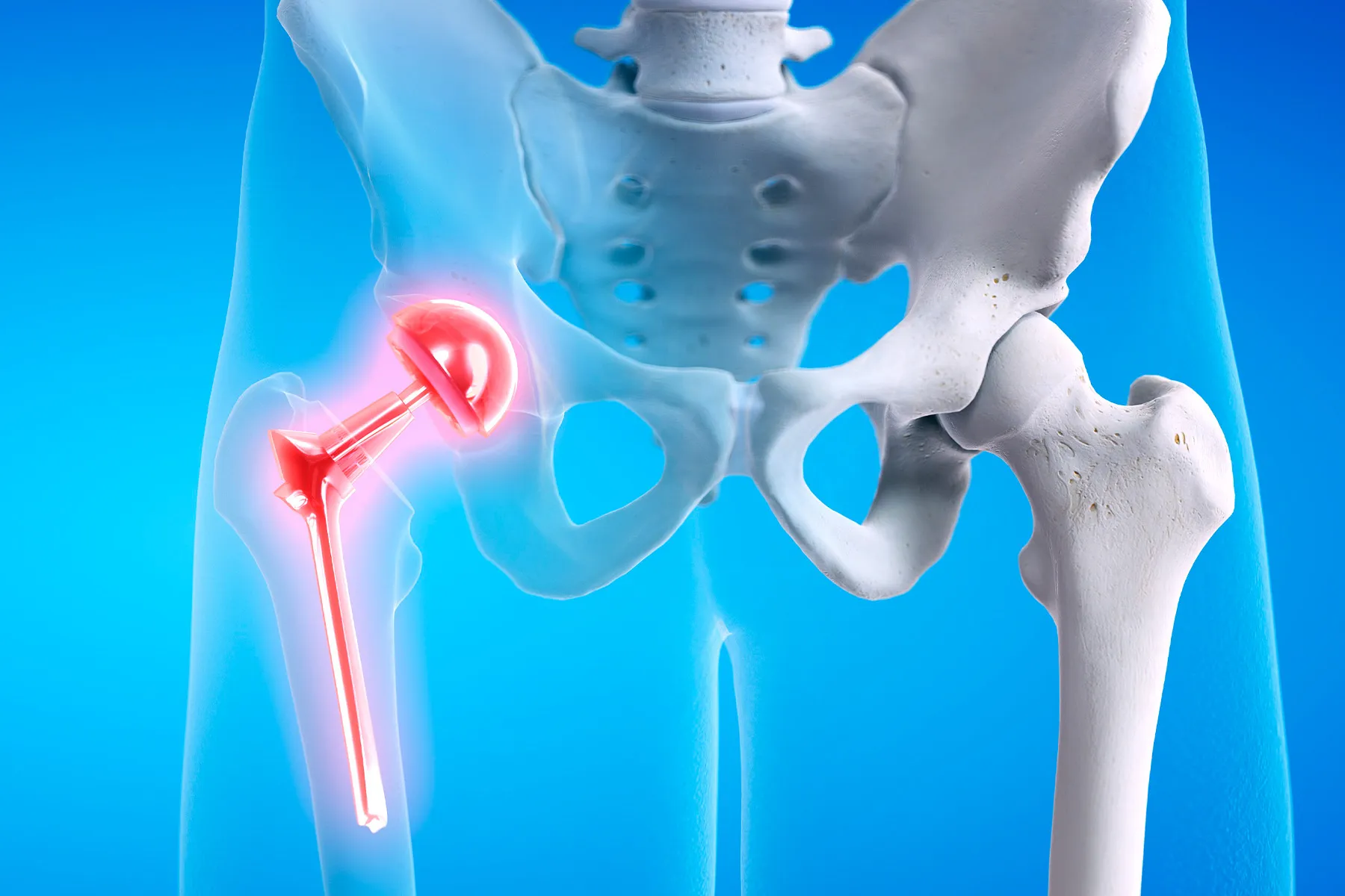 photo of joint replacement