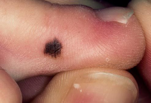 dark spot on toe