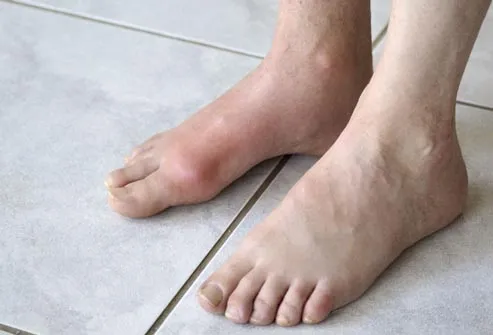 feet with gout