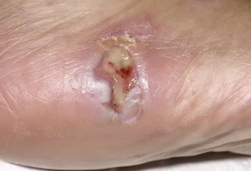 oozing wound on foot