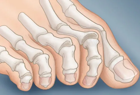 illustration of claw toe