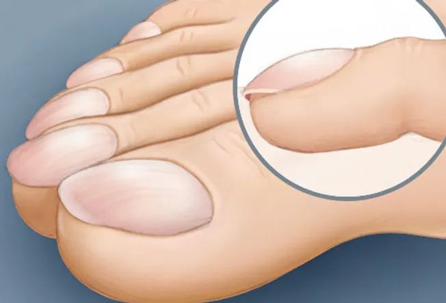 illustration of clubbed toes