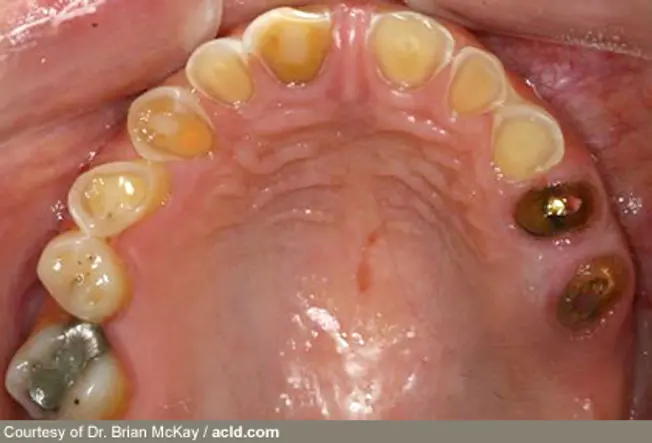 Eating Disorders Erode Tooth Enamel
