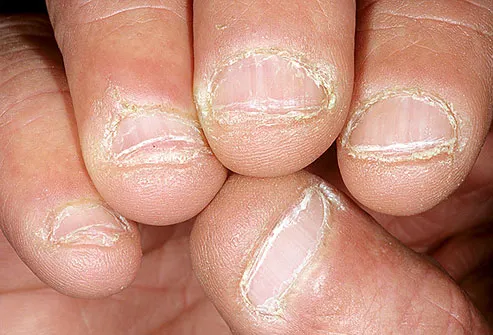 Bitten fingernails