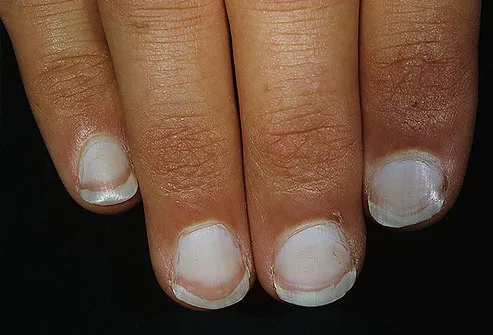 Fingernail beds that are almost completely white