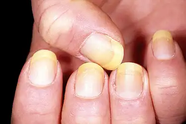What Your Fingernails Say About Your Health Ridges Spots Lines Bumps And More