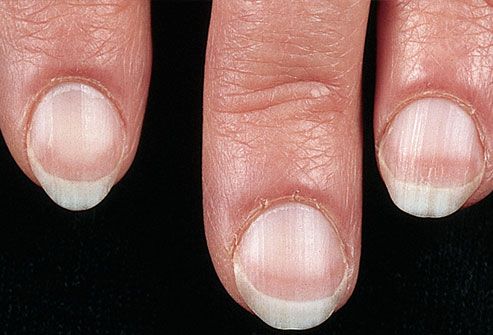 Pale fingernail beds on woman's hand