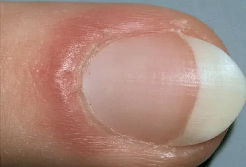Inflammation of the nail fold