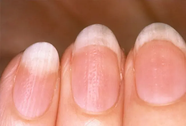 Rippled Nails