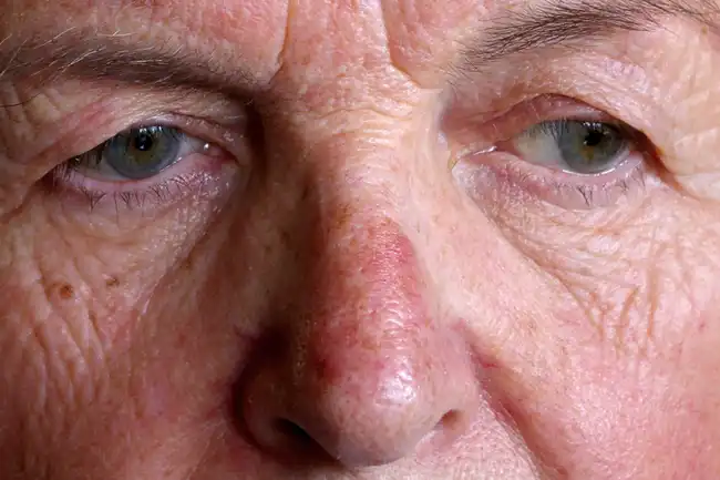 mature woman with rosacea