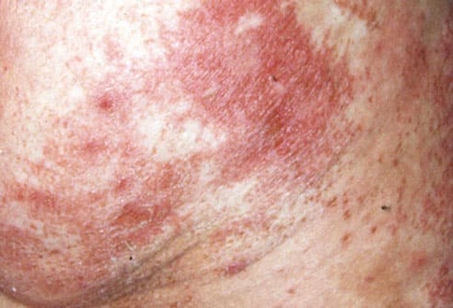 Scaly Rash on Buttocks, Red Tongue