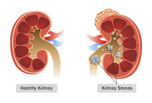 kidney stones illustration