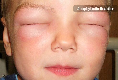 child with anaphylactic reaction