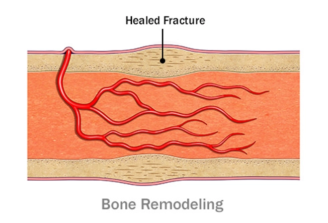 Bone Repair: Step 4