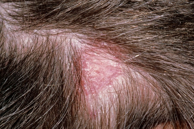 Scalp Infection