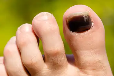 Pictures Of Toenail Colors And What They Mean