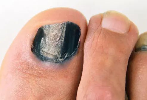 big black toe