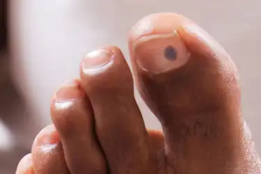 Black dot toenail small on black dot