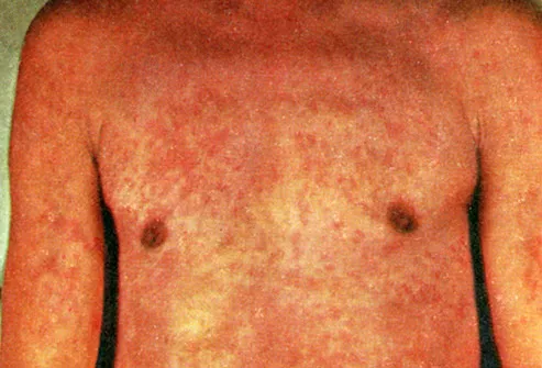 Pictures Of Blotchy Skin Rosacea Hives Psoriasis And More