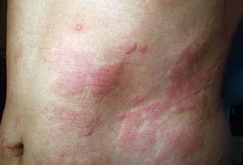 Pictures Of Blotchy Skin Rosacea Hives Psoriasis And More