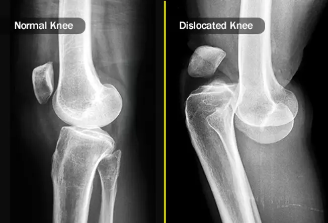 Dislocations and Fractures