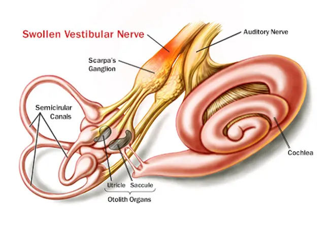 Vestibular Neuronitis