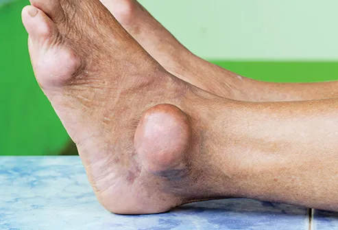 heel pain and swelling ankle