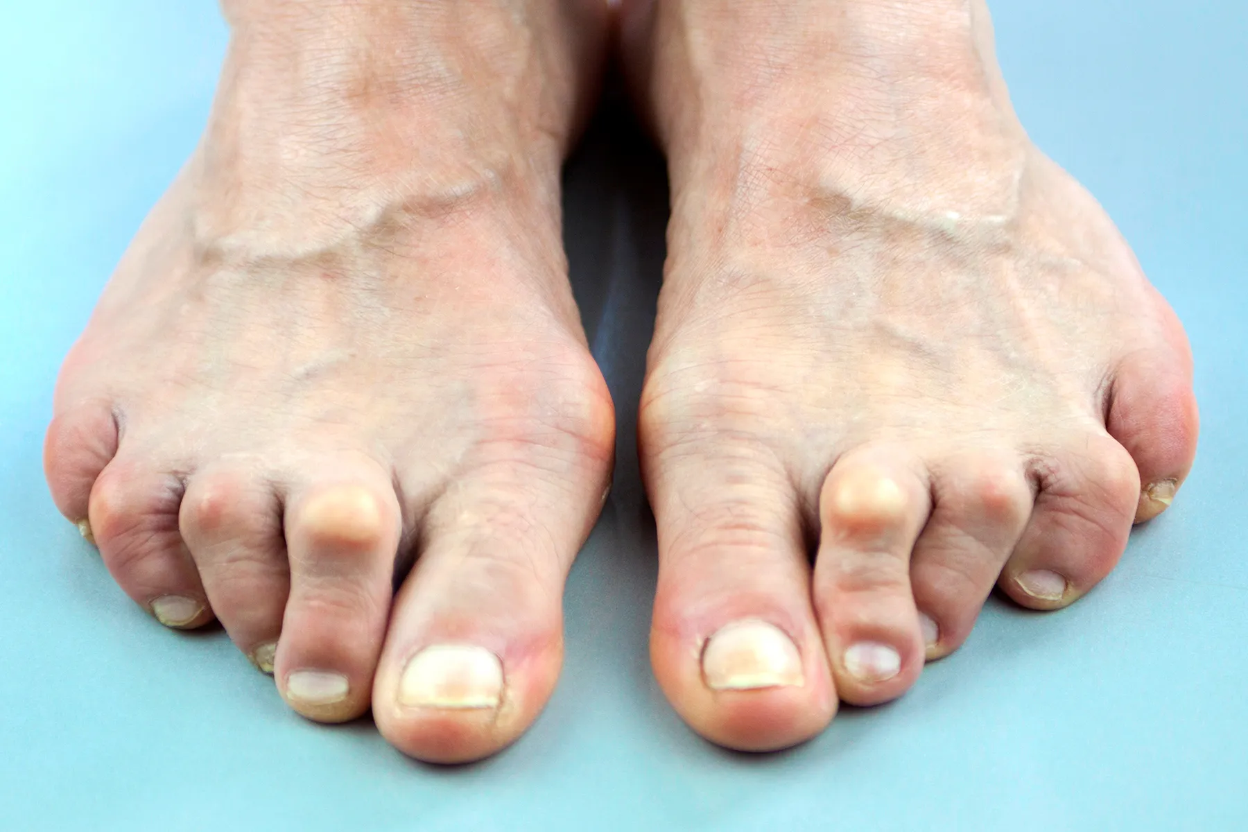 pop in arch of foot