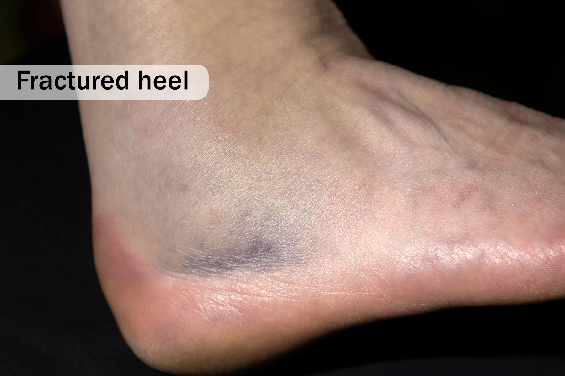 bruised sole of foot