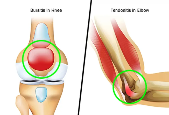 bursitis and tendonitis diptych