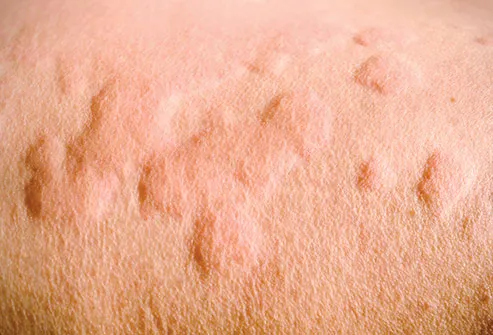 allergic skin reaction close up