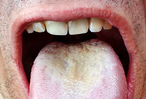 candidiasis tongue