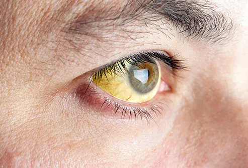 mắt vàng từ vàng da