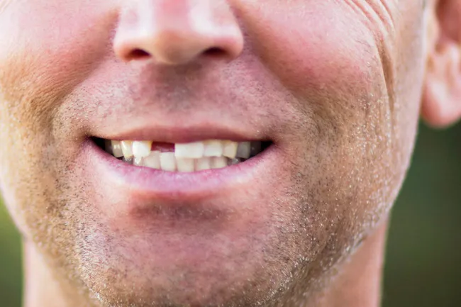 photo of smiling man with missing teeth