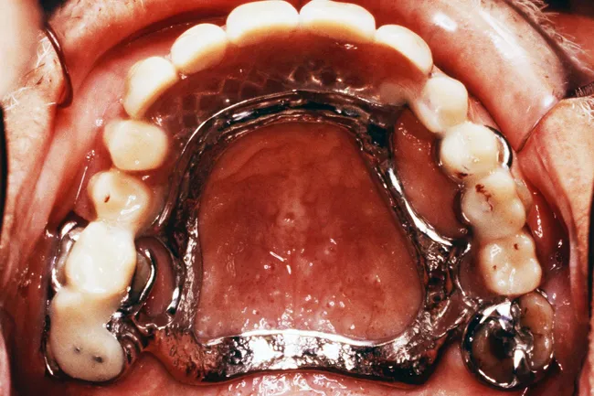 photo of partial dentures