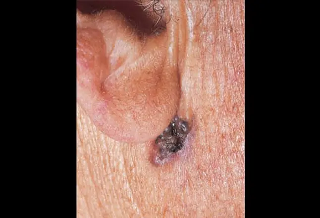 Picture of Basal Cell Carcinoma