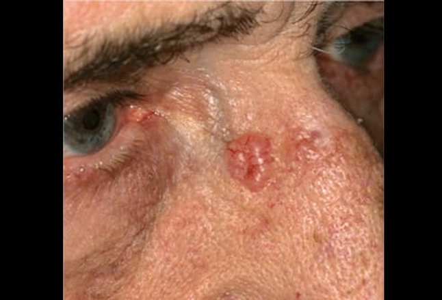 Picture Of Basal Cell Carcinoma On The Nose
