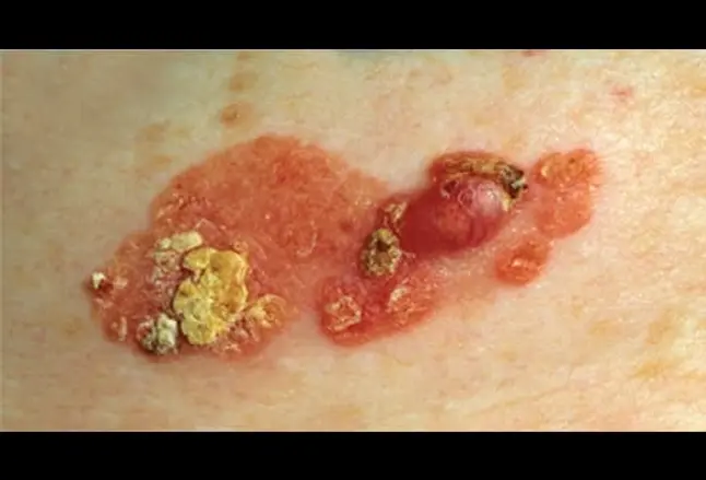 Picture of Squamous Cell Carcinoma