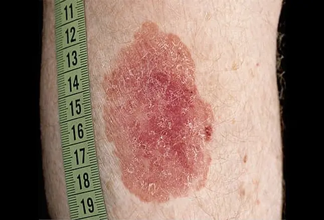 Picture of Squamous Cell Carcinoma on the Calf